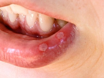 Canker-Sores-Causes-and-Treatment.jpg