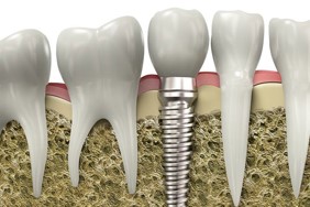 Implanturi-Dentare-in-Romania.jpg