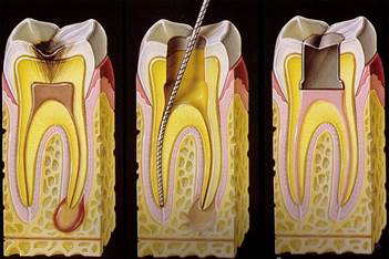 Root-Canal-Treatments.jpg