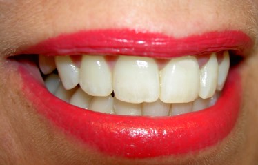 Teeth_Whitening.jpg