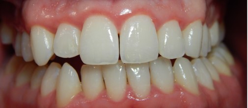 Gingivitis Treatments in Romania