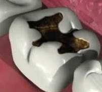 Tooth Decay Treatment in Romania